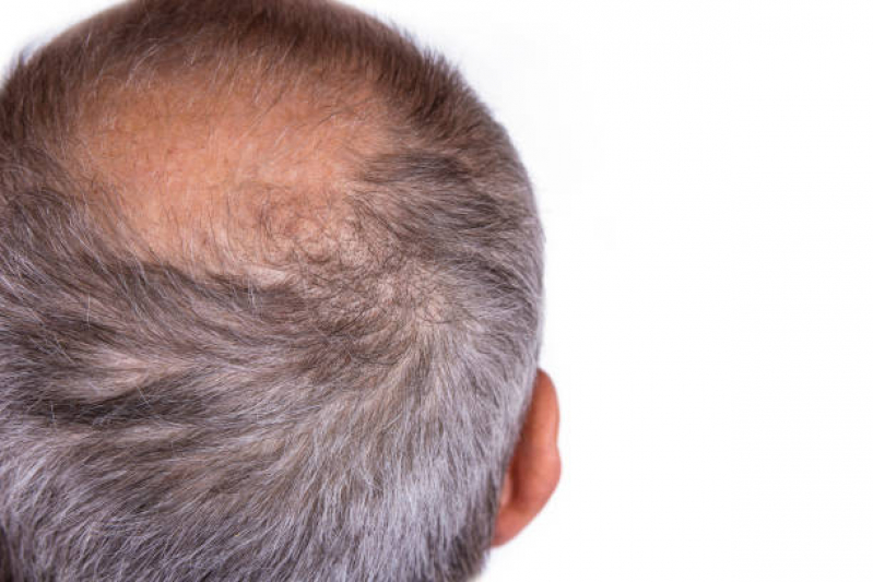 Alopecia Androgenética em Mulheres Tratamento Vila Eureka - Calvície Androgenética Mogi das Cruzes