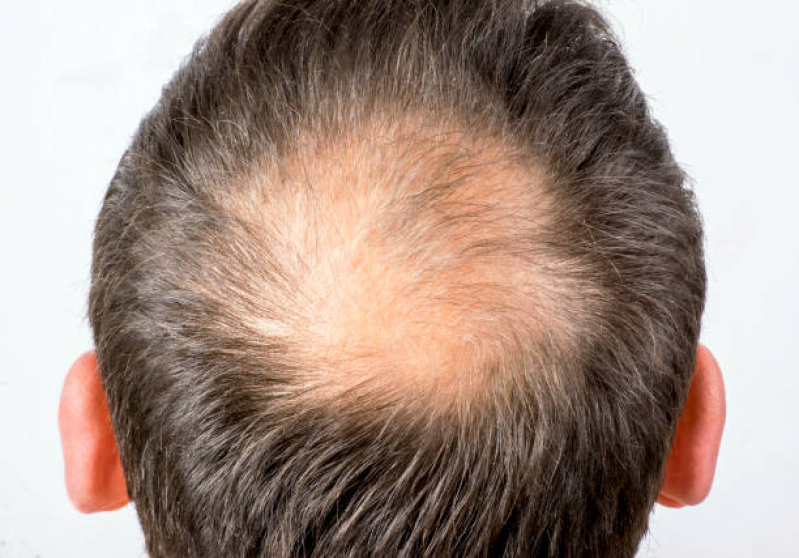 Alopecia Androgenética em Mulheres Parque do Colégio - Alopecia Androgenetica Frontal