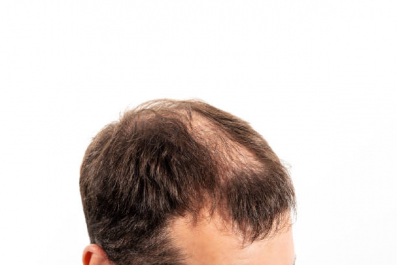 Alopecia Androgenetica Frontal Tratamento Lapa - Calvície Androgenética Mogi das Cruzes