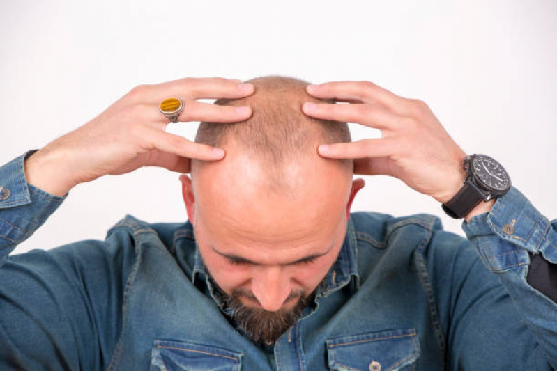 Alopecia Androgenetica Frontal Jardim São José - Alopecia no Cabelo Masculino