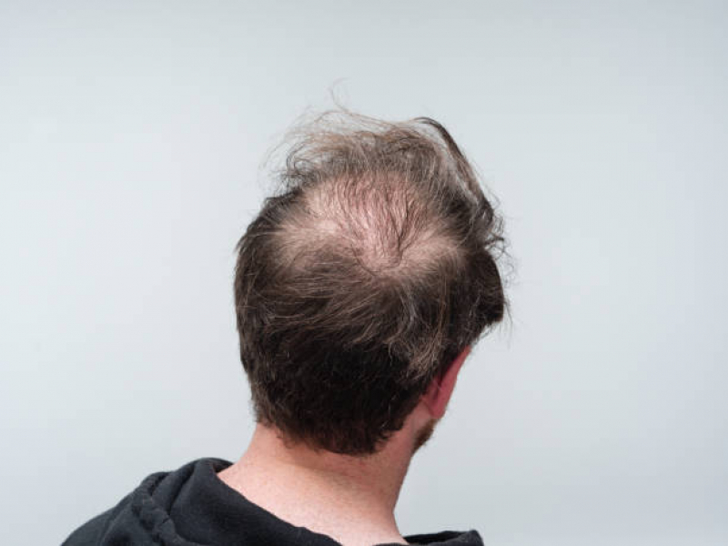 Alopécia Androgenética Masculina Tratamento Jardim Monte Cristo - Alopecia no Cabelo Masculino