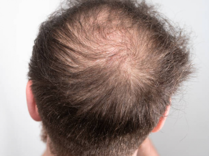 Alopécia Androgênica Tratamento Jd. Nova América - Alopecia no Cabelo Masculino