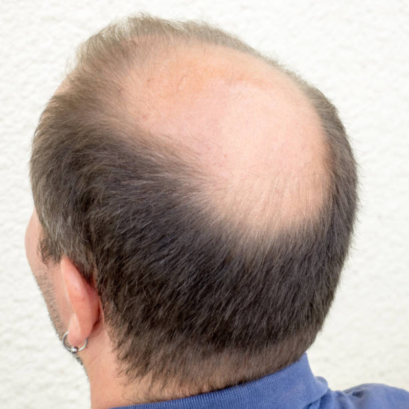 Alopecia no Cabelo Masculino Tratamento Vila Santa Maria - Calvície Androgenética Mogi das Cruzes