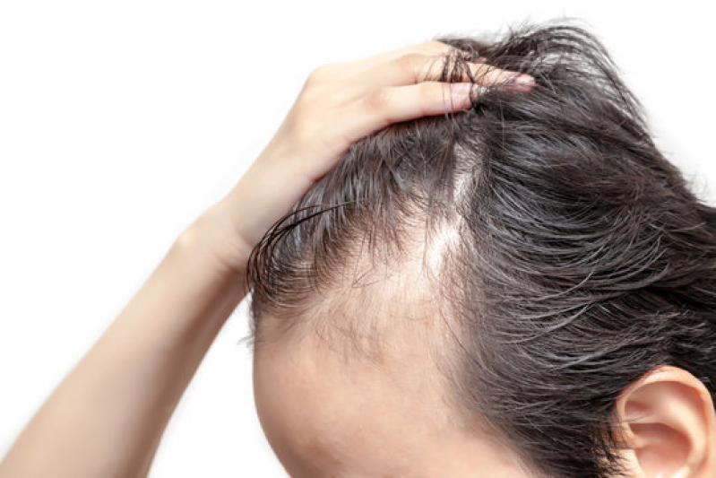 Alopecia no Cabelo Masculino Biritiba - Alopecia Androgenética em Mulheres