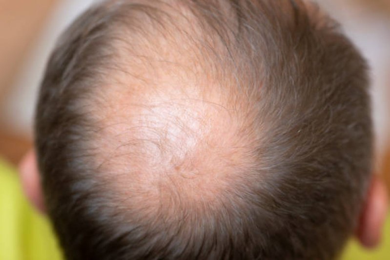 Alopécia Padrão Feminino City Lapa - Alopecia no Cabelo Masculino