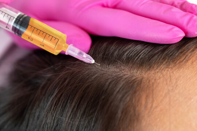 Microagulhamento para Couro Cabeludo Agendar Jardim Madre Ângela - Microagulhamento Capilar para Alopecia