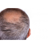 Alopecia Androgenética em Mulheres