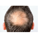 alopecia androgenética em mulheres Alto da Lapa