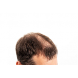 alopecia androgenetica frontal tratamento Vila Mazza
