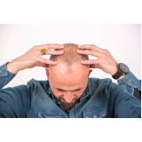 alopecia androgenetica frontal Alto do Boa Vista