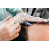alopécia masculina tratamento Vila Romana