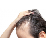 alopecia no cabelo masculino Vila Romana