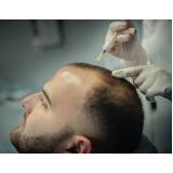 clínica para queda de cabelo em homens Lar das Flores