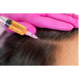 clínica que faz microagulhamento para crescer cabelo Alto do Ipiranga
