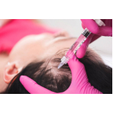 clínica que faz prp para cabelo parar de cair Várzea da Barra Funda