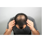 clínica que faz tratamento para queda de cabelo masculino Jardim Castelo