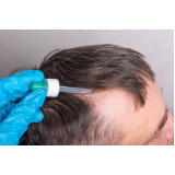clínica que faz tratamento para queda de cabelo Biritiba