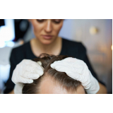 dermatologista especialista em queda de cabelo Vila Ararat