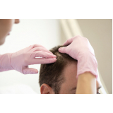 especialista em queda de cabelo em homens Lar das Flores