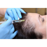 mesoterapia para cabelo marcar Vila Santa Luíza