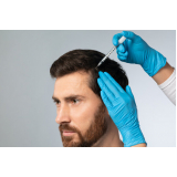 microagulhamento para cabelo marcar Lapa alta
