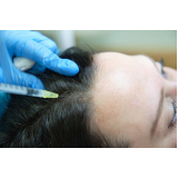 onde fazer tratamento para crescimento de cabelo Vila Amorim