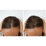 queda de cabelo em mulheres tratamento Cidade Kemel