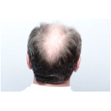 tratamento contra queda de cabelo Centro