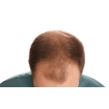 tratamento de alopecia androgenetica frontal Núcleo Itaim
