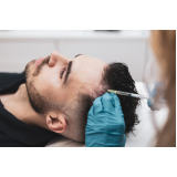tratamento de microagulhamento para cabelo Vila Amorim