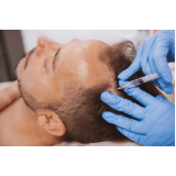 tratamento de prp no couro cabeludo Vila Rea