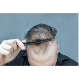 tratamento para queda de cabelo masculino agendar Recreio Sertãozinho