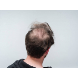 tratamentos para alopecia androgenetica frontal Vila Rea