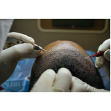 tricologia queda de cabelo clínica Biritiba