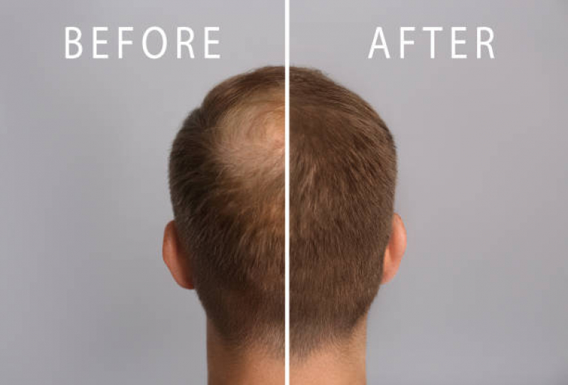 Tratamento de Alopecia Androgenética em Mulheres Vila Romana - Alopecia no Cabelo Masculino