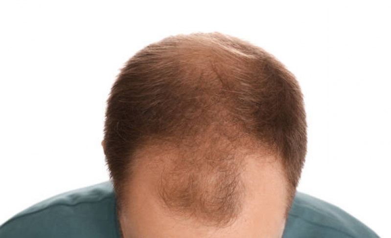 Tratamento de Alopecia Androgenetica Frontal Mogilar - Calvície Androgenética Suzano