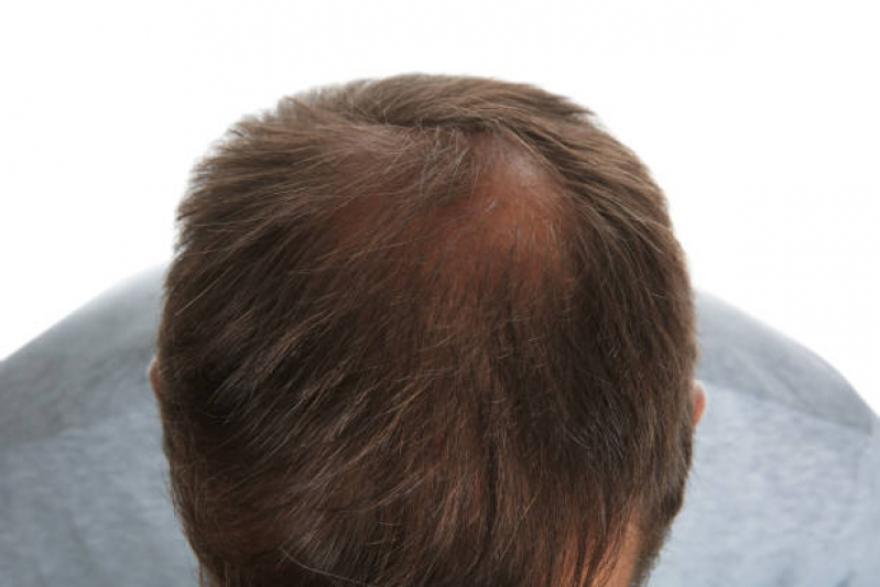 Tratamento de Alopécia Androgenética na Adolescência Jd. São Luiz - Alopecia Androgenetica Frontal