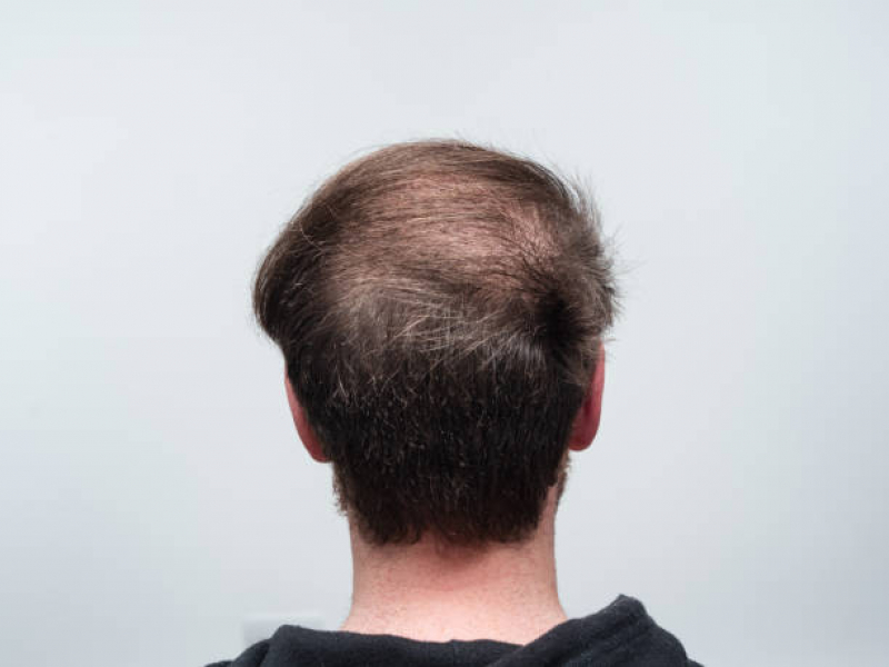 Tratamentos para Alopecia Androgenética em Mulheres Vila dos Ferroviários - Alopecia no Cabelo Masculino